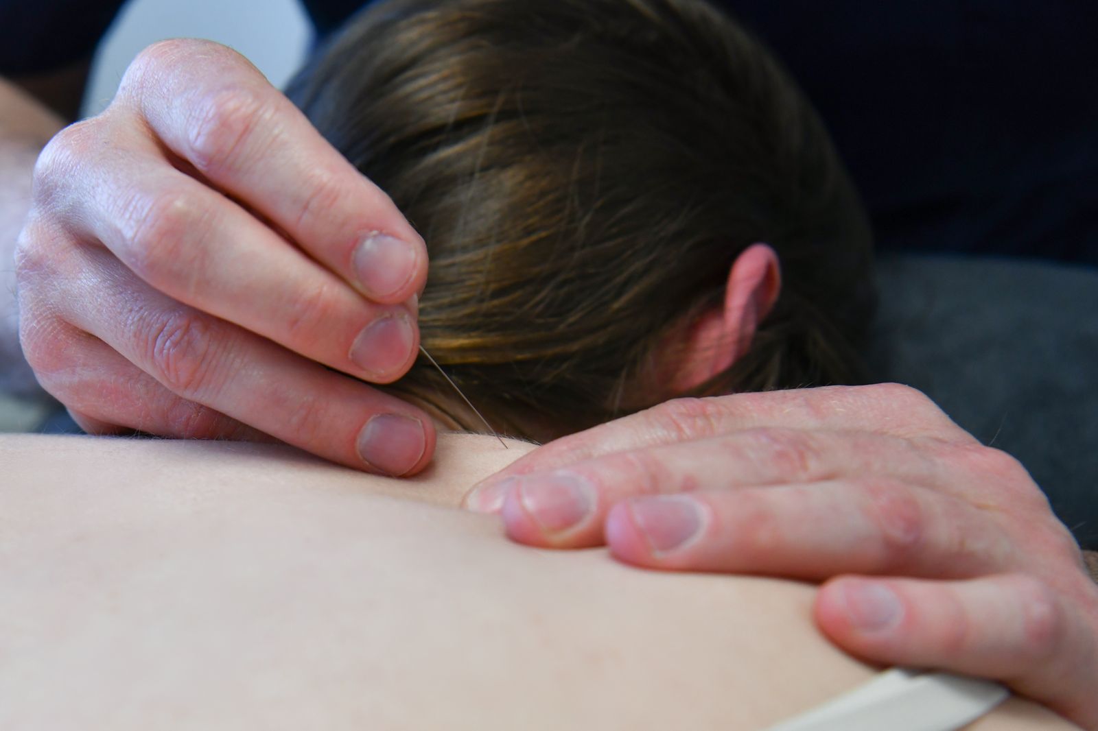 Behandeling met dry needling in de nek- en schouderspieren